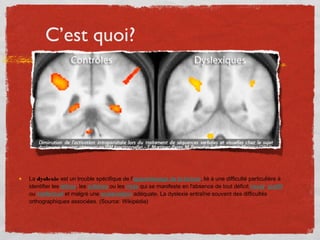 C’est quoi?
La dyslexie est un trouble spécifique de l'apprentissage de la lecture, lié à une difficulté particulière à
id...